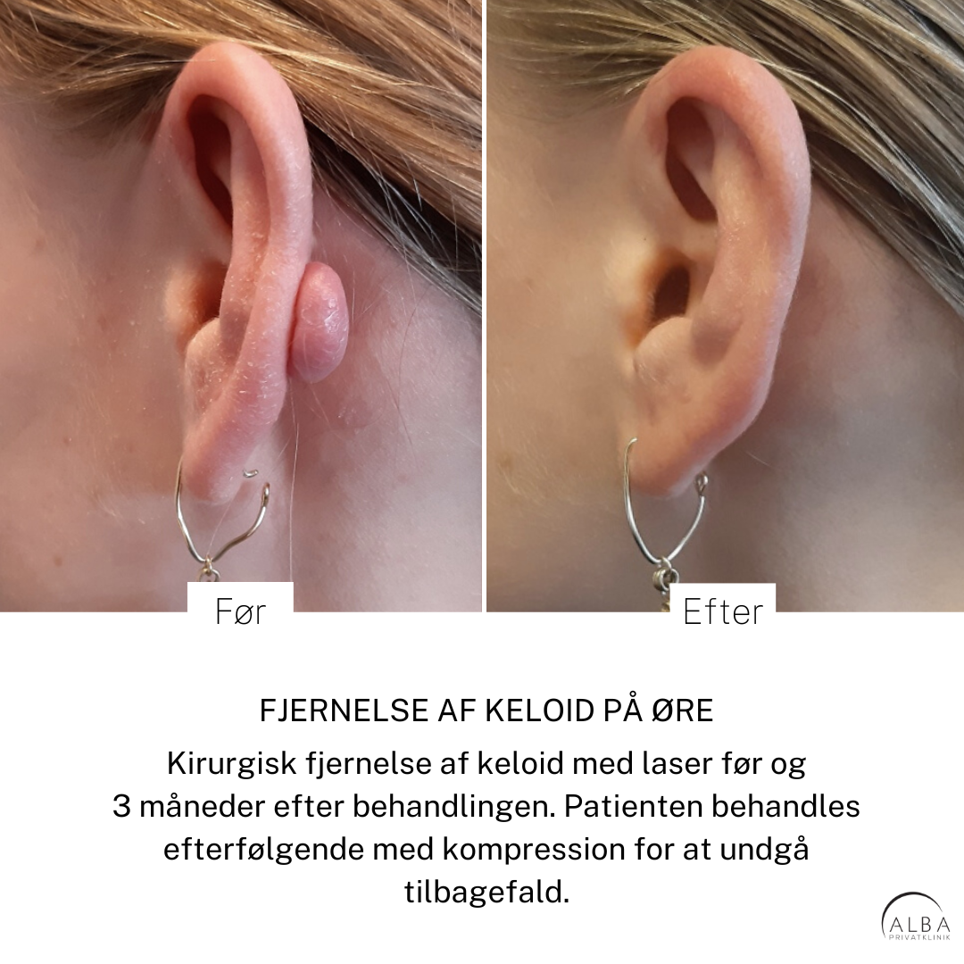 Behandling af keloid på øre - Før og efter - Alba Privathospital