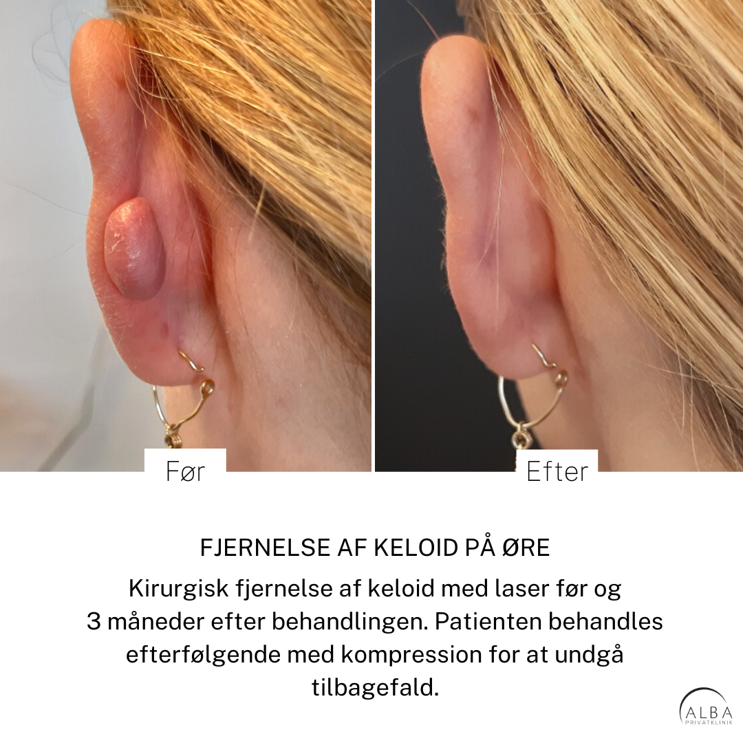 Behandling af keloid på øre - Før og efter - Alba Privathospital